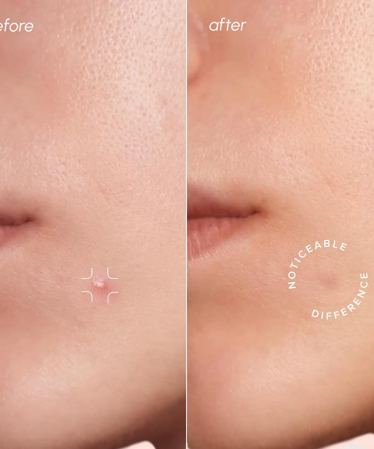 Invisible Pimple & Acne Patches