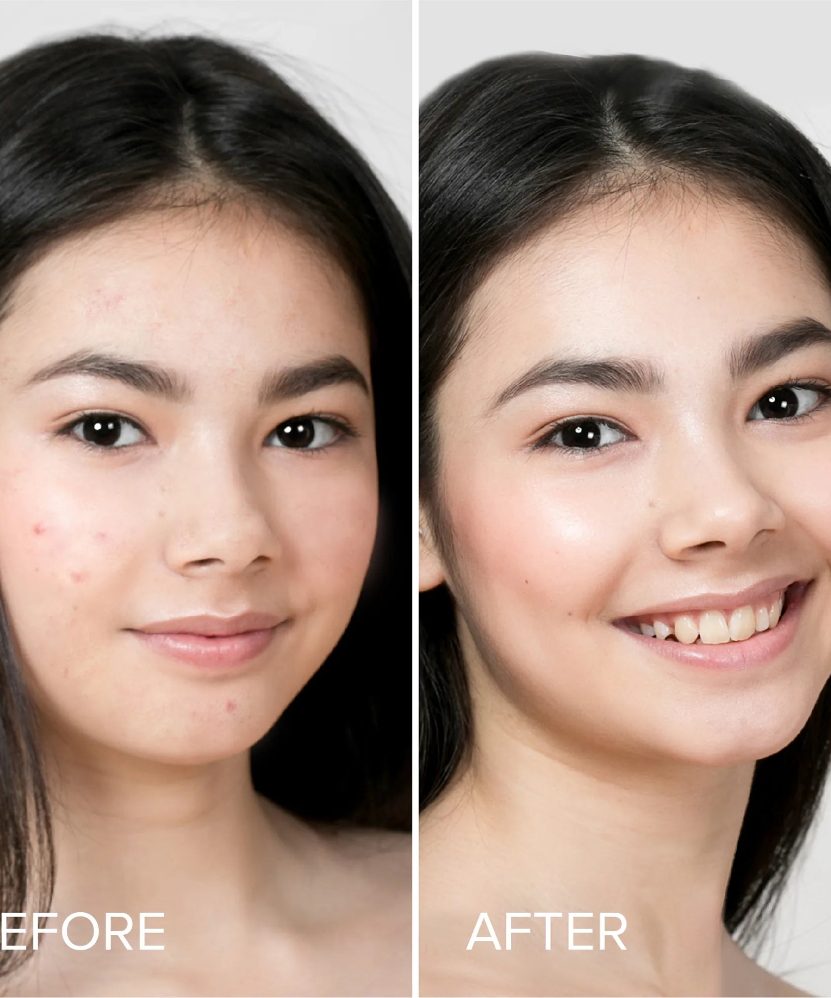 Pimple & Acne Patches