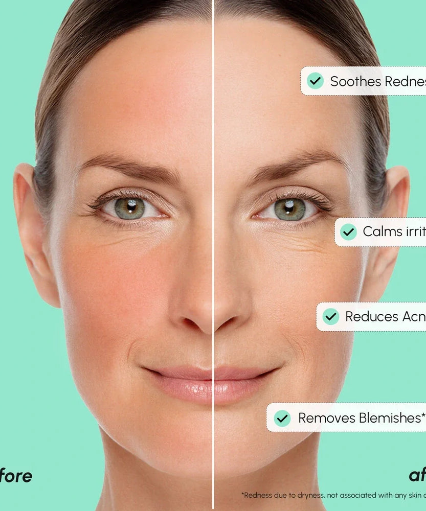Redness Soothing Azelaic Acid Serum