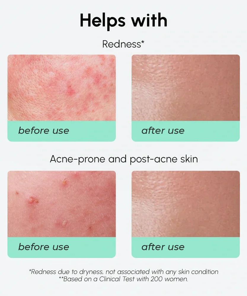 Redness Soothing Azelaic Acid Serum
